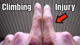 How I Injured My Finger Climbing  Recovery Strategy [upl. by Neumann]