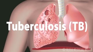 Tuberculosis TB Progression of the Disease Latent and Active Infections [upl. by Berni]