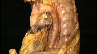 AclandAnatomycom Aclands Video Atlas of Human Anatomy Aortic Arch [upl. by Ardnuassak296]