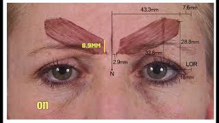 Indepth Guide To Treating The GlabellaForehead With Botox  Dr Chris Hutton [upl. by Esten]