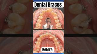 Dental BracesBefore …Afterviral youtubeshorts oralhealth smile dentist fashion twitch ort [upl. by Royce]