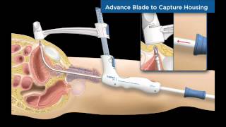 TSPeC® Illustrated Procedure  English [upl. by Billat925]