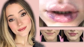 FIRST TIME LIP FILLER VLOG AND EXPERIENCE [upl. by Secrest]