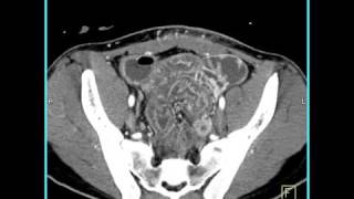 Abdomen Small Bowel EnteritisSeries of coronal sagittal volume rendered and MIP images4 of 6 [upl. by Haily]