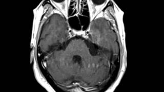 HSV Encephalitis [upl. by Nahn543]