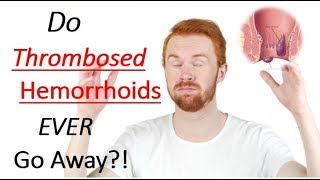 Do THROMBOSED HEMORRHOIDS Go Away On Their Own  How to Get a Thrombosed Hemorrhoid To Go Away FAST [upl. by Craggie]