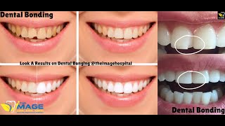 Look A Results on Dental Bonging theimagehospital [upl. by Unders572]