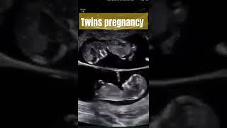 Twins pregnancy ultrasoundwhat does multiple pregnancy looks like on ultrasound [upl. by Nodaj]