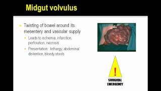 Pediatric Board Review of Malrotation for COMLEX USMLE [upl. by Roman]