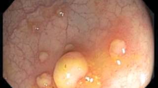 Colonoscopy Channel  Pseudomembranous colitis [upl. by Aurelius44]