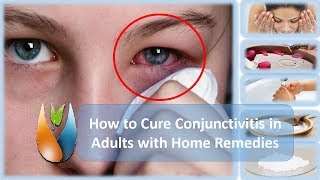 How to Cure Conjunctivitis in Adults with Home Remedies [upl. by Aplihs]