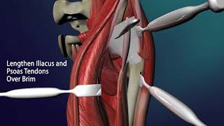 Open Reduction of Congenital Hip Dislocation [upl. by Maridel]