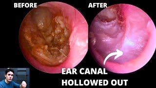 The Importance Of Angled Endoscopes Hidden Pathology [upl. by Aham]