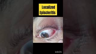 Localized Episcleritis  eyediseases LocalizedEpiscleritis [upl. by Hatokad971]