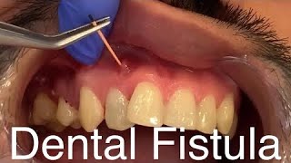 Best Compilation videos of Dental Fistula or Parulis cases  Dental Abscess Dental Infections [upl. by Marielle197]