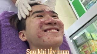 ROLLING NEEDLE REMOVE ACNE SCARS FOR VIET ANH  Hang Oliver [upl. by Kcirdek]