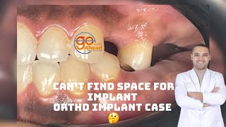 how to gain space in ortho implant cases [upl. by Mit393]