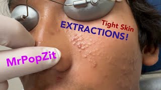 Tight skin acne extractions Comedonal acne with some inflammatory nodules Great session must see [upl. by Ammadas521]