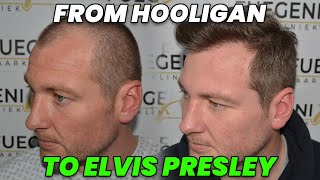 From Hooligan to Elvis Presley  Hair Transplant  FueGenix  Dr Munib Ahmad [upl. by Latonia229]