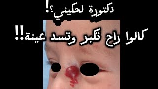 Infantile Hemangioma ورم الأوعية الدموية درند حمزة [upl. by Valleau]