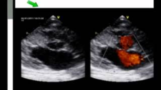 Systolic Murmurs in HOCM [upl. by Ettelorahc]