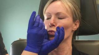 Botox in the neck for a smoother tighter look [upl. by Azmuh]