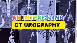 CT UROGRAPHY ।। An Interesting Case ctscan cturography urography urology urologysurgery yt [upl. by Gweneth]