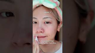 Facial Pores Cleaning Pads skincare acnetreatment skincareproduct skincareroutine skin [upl. by Haidadej]