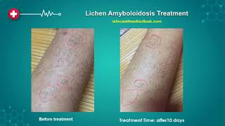 Successfull Lichen Amyloidosis Treatment Lichen Amyloidosis Cure 20192022 [upl. by Undis393]