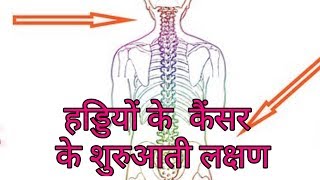 हड्डियों के कैंसर के लक्षणhaddi ke cancer ke lakshanbone cancer symptoms hindi [upl. by Ahsietal433]