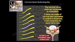 Cervical Radiculopathy  Everything You Need To Know  Dr Nabil Ebraheim [upl. by Tatianas]