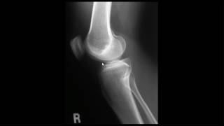 Lateral Knee Finding the Lateral Notch [upl. by Fernandez]