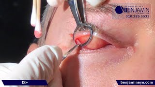 Effective Stye removal procedure in the office [upl. by Lowney]