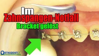 Im ZahnspangenNotfall ein Bracket hat sich gelöst feste Zahnspange Kieferorthopöde  Orthodentix [upl. by Enomas176]