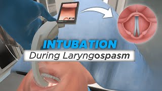 Intubation during Laryngospasm [upl. by Riamo353]