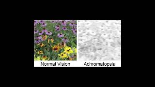 Achromatopsia Symptoms and Causes  Diagnosis  Treatment  Prevention healthcare [upl. by Alburg32]