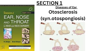 chap 13 Otosclerosis  ENT dhingra complete chapter quick review [upl. by Orutra]