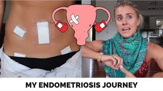 ENDOMETRIOSIS  Symptoms Surgery and what now Ashley Freeman [upl. by Gildus320]