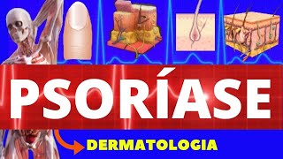 PSORÍASE  CAUSAS SINTOMAS E TRATAMENTO  CARACTERÍSTICAS DA PSORÍASE  DERMATOLOGIA [upl. by Knut205]