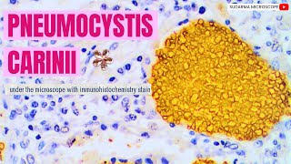 Pneumocystis carinii under the microscope with Immunohistochemistry stain [upl. by Atsahc978]