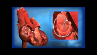 Ablation for AV Node Reentrant Tachycardia AVNRT [upl. by Atteroc]