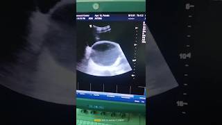 ultrasoundguidanchematometra ultrasoundytshorts viral foryou [upl. by Reemas]