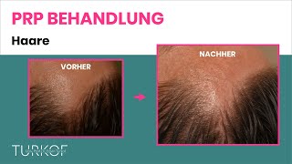 PRP Haare  Eigenbluttherapie bei Haarausfall  Dr Turkof  1060 Wien [upl. by Nocaj311]