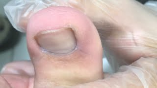 Thumb Swollen Treatment Paronychia [upl. by Hayden200]