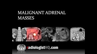 Malignant Adrenal Masses [upl. by Schechinger]