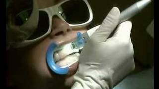 Laser Whitening [upl. by Toomay]