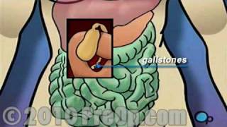 Gallbladder Removal Laparoscopic PreOp® Patient Education Feature [upl. by Leugar]