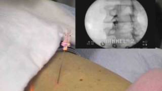 Lumbar Facet Joint Injection  PalmHarborOrthocom [upl. by Brooking]