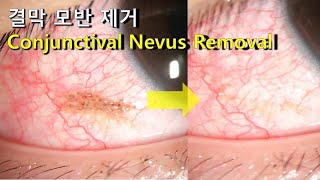 결막 모반 제거 Conjunctival nevus removal [upl. by Inattirb]