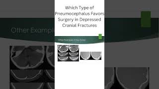 Which Type of Pneumocephalus Favors Surgery in Depressed Cranial Fractures [upl. by Sven113]